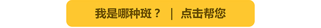 我是哪种雀斑？点击帮您