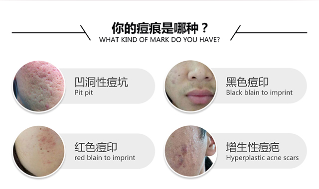 你是痘痕是哪种