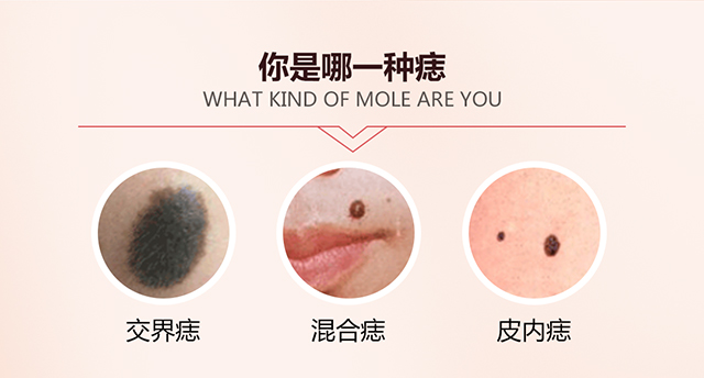 你是哪一种痣