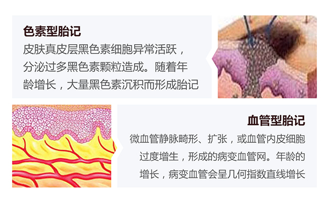 色素型胎记