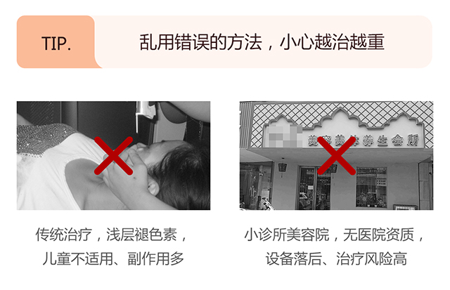 血管性胎记