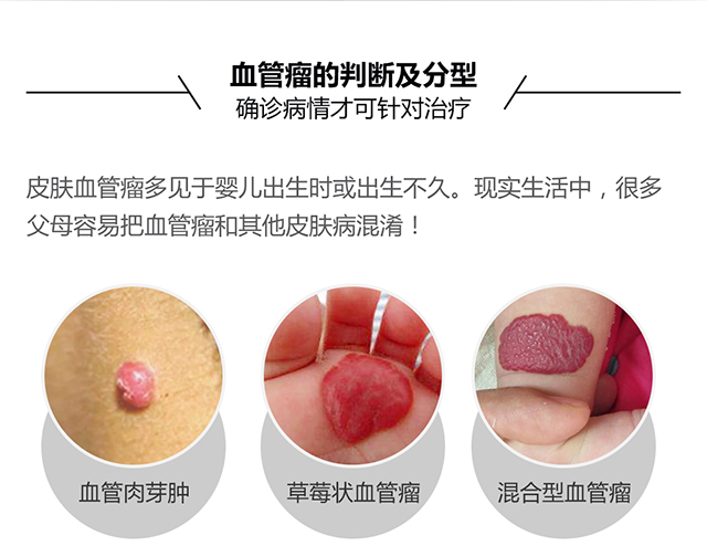 血管瘤判断及分型