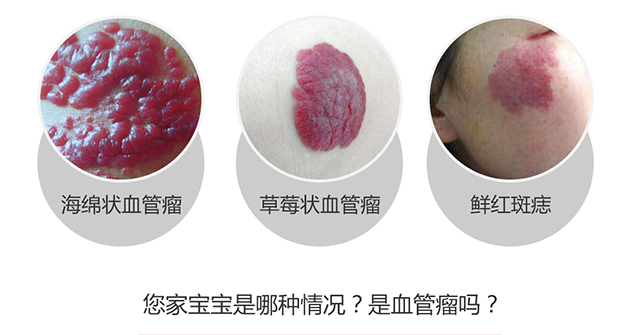 草莓状血管瘤